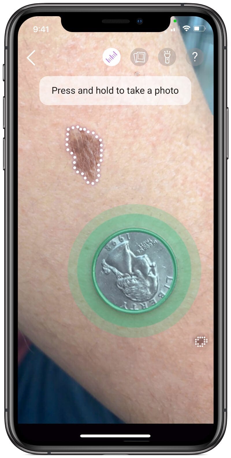 Take photos of the moles with Miiskin App Track changes in skin with app