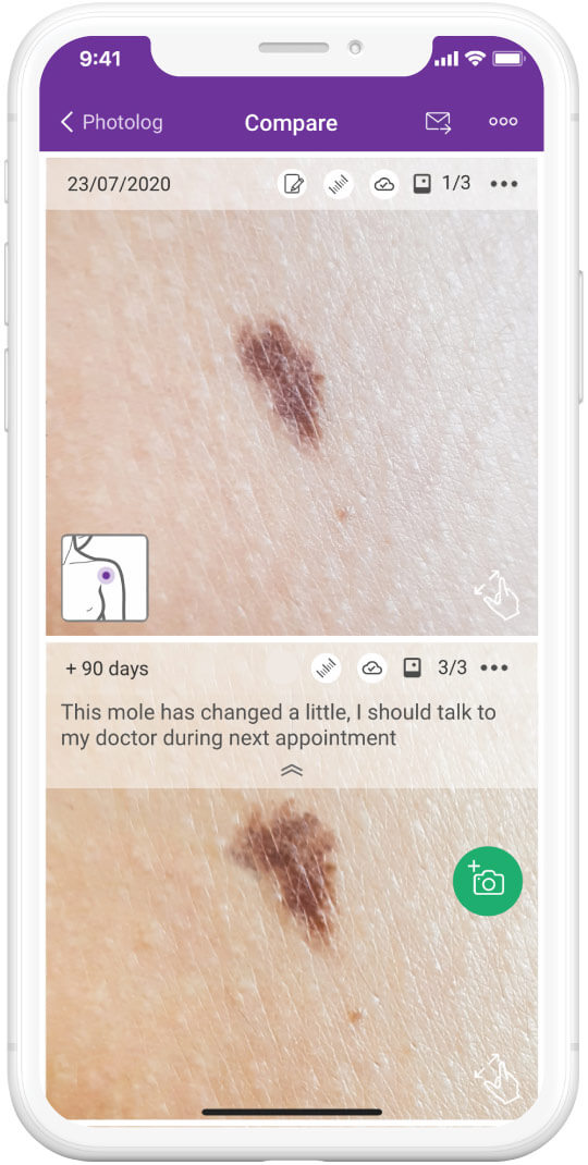 Take photos of your skin and moles over time period