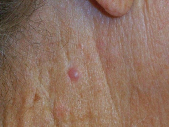 skin-lesions-types-pictures-prevention