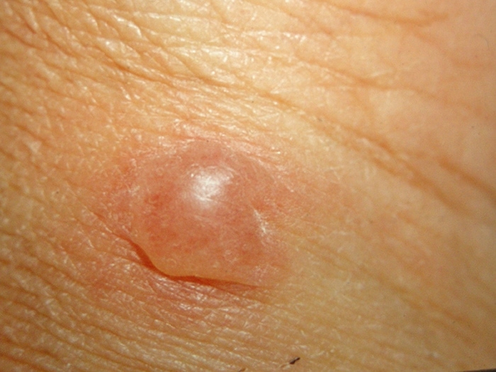 blister on the skin