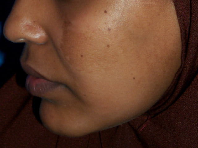 brown spots on the skin melasma