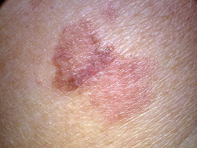 hypomelanotic melanoma
