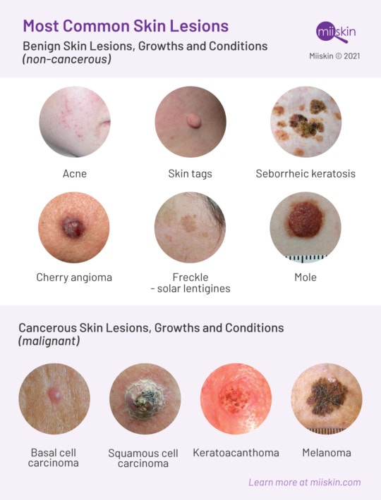 skin lesions and conditions