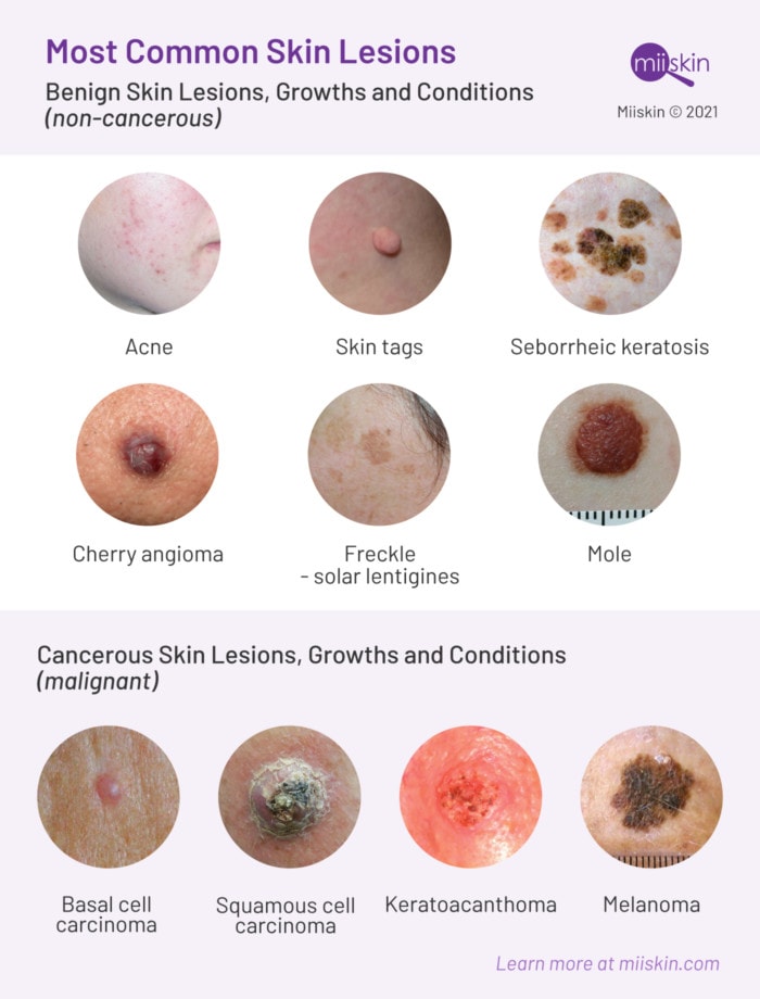 Skin Lesions: Types, Pictures & Prevention