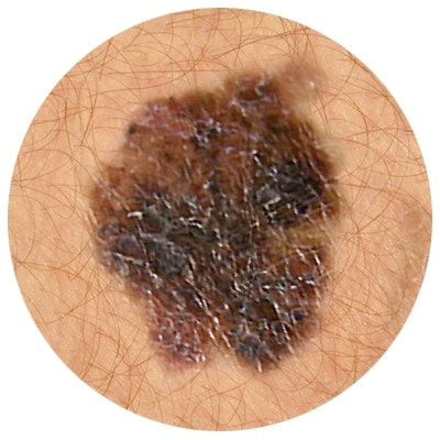 Abcde melanoma - irregular borders of mole