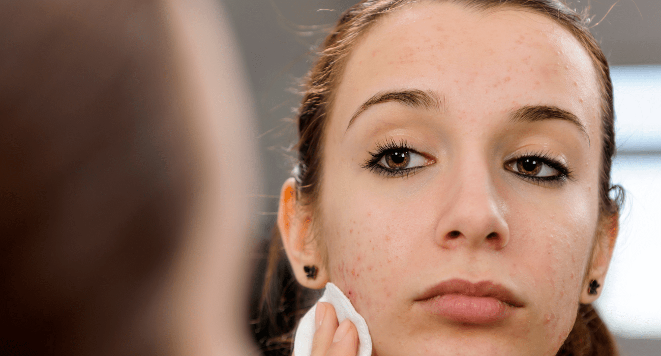 self care tips for acne