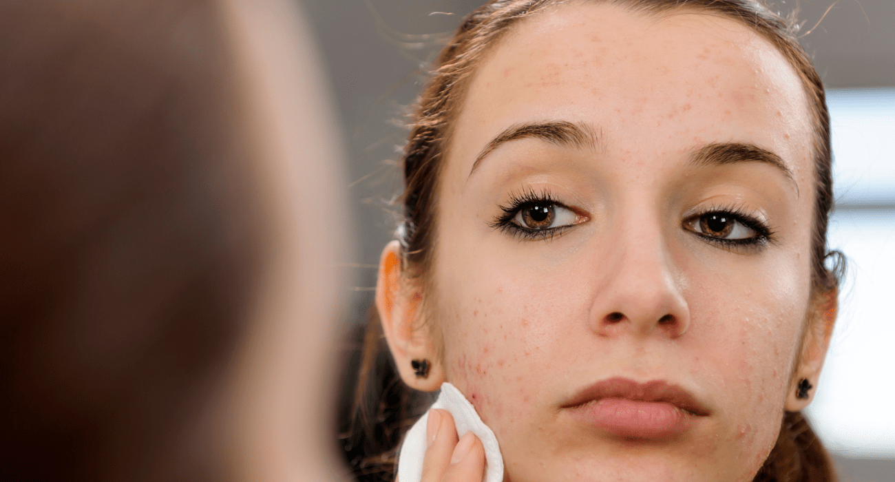 Acne Self Care Guide Taking Care Of Your Skin