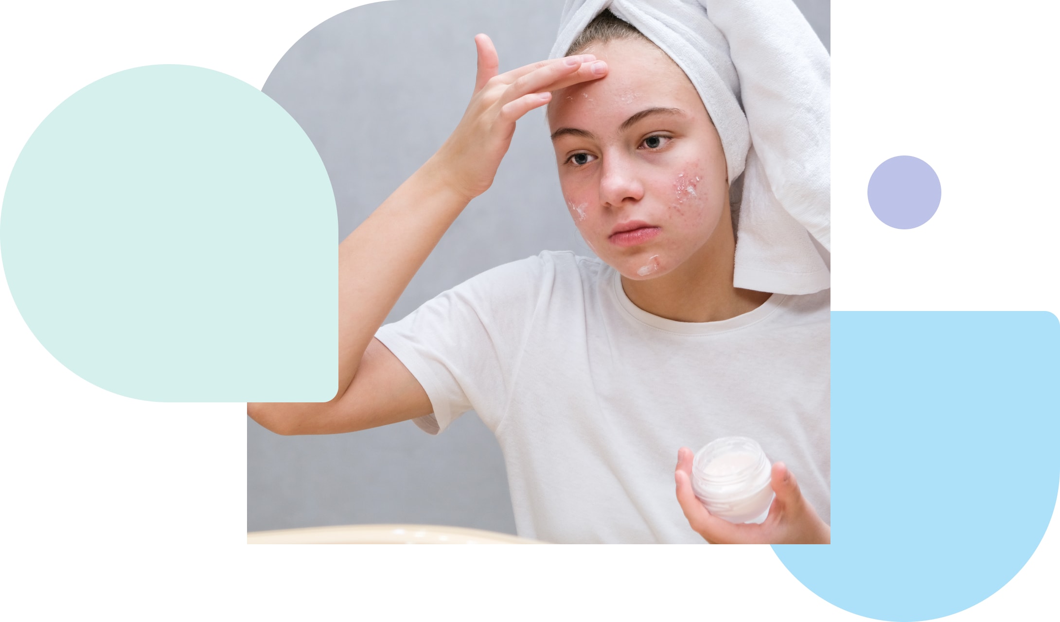 treating acne with tretinoin