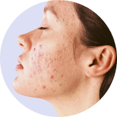 Skin roughness treatment