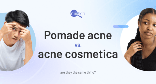 acne cosmetica vs pomade acne