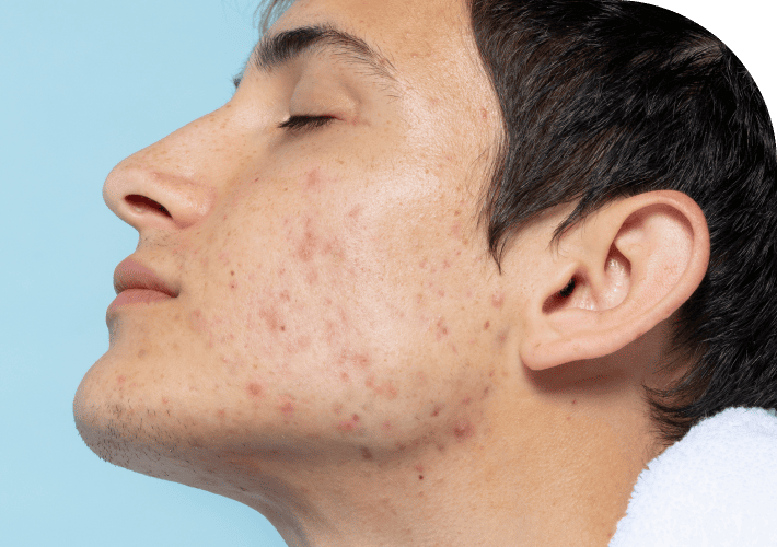 Hormonal Acne Treatment