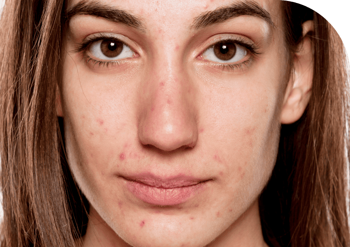 Mild-acne Treatment