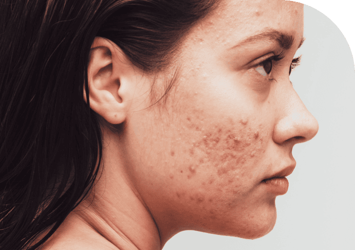 Moderate Acne Treatment