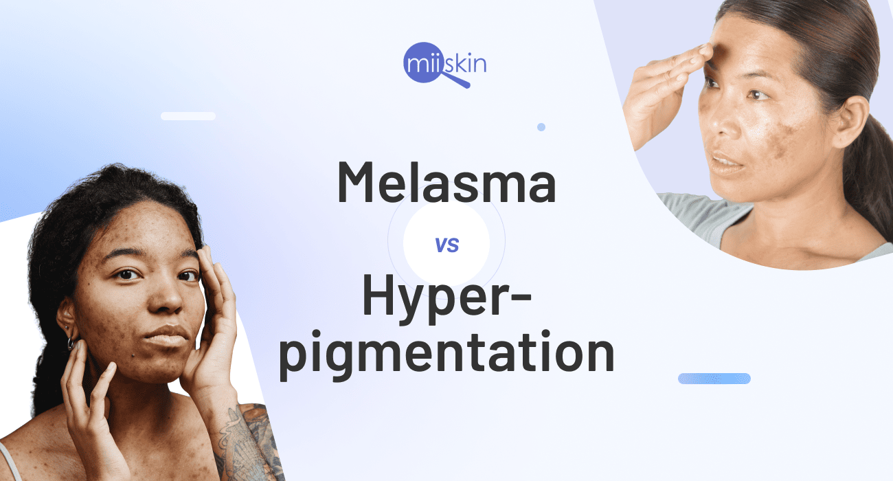 melasma and hyperpigmentation skin conditions