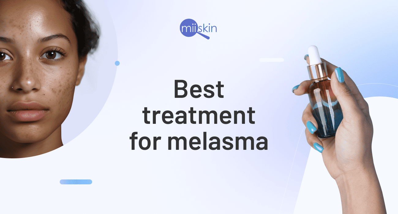 best melasma treatment