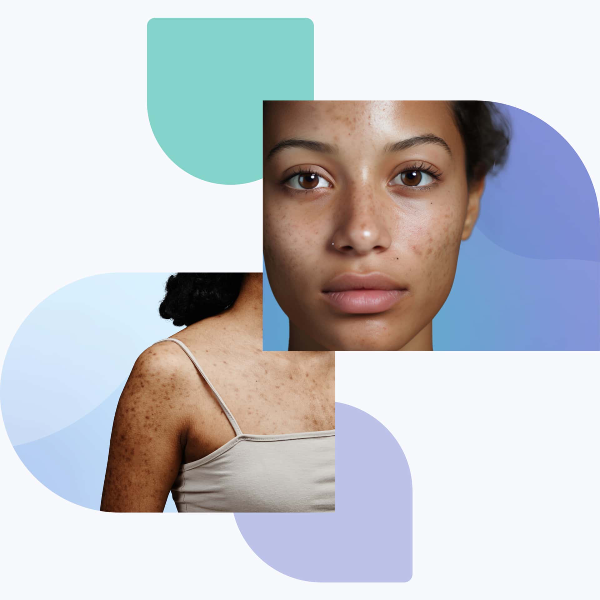 Melasma vs hyperpigmentation: What is the difference?