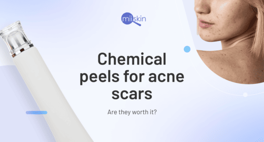 using chemical peels for acne and scars