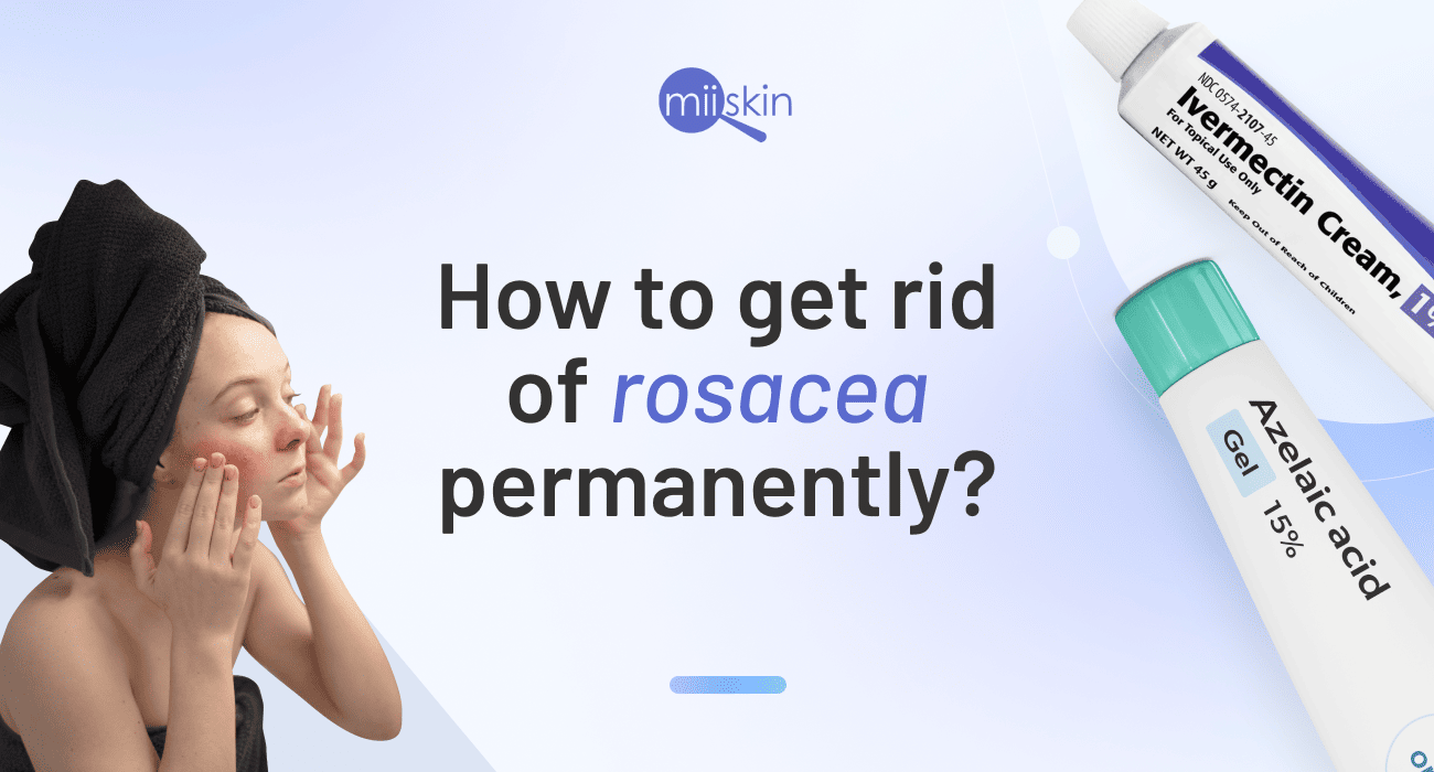 get rid of rosacea permanently
