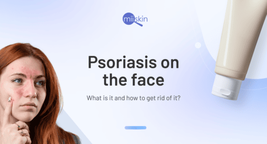 facial psoriasis