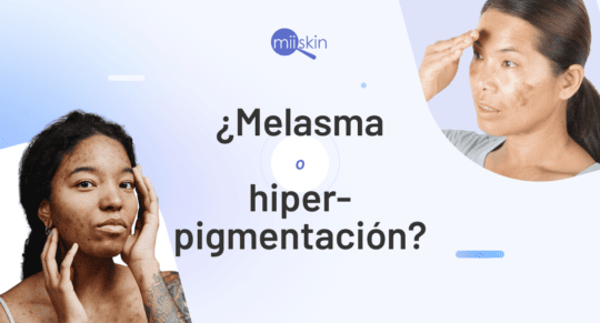 hiperpigmentacion y melasma