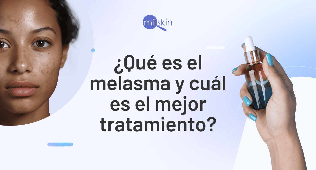 melasma tratamiento