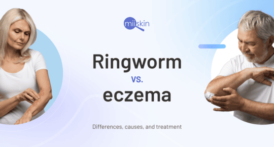 eczema vs ringworm