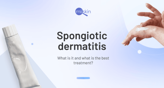 what is spongiotic dermatitis
