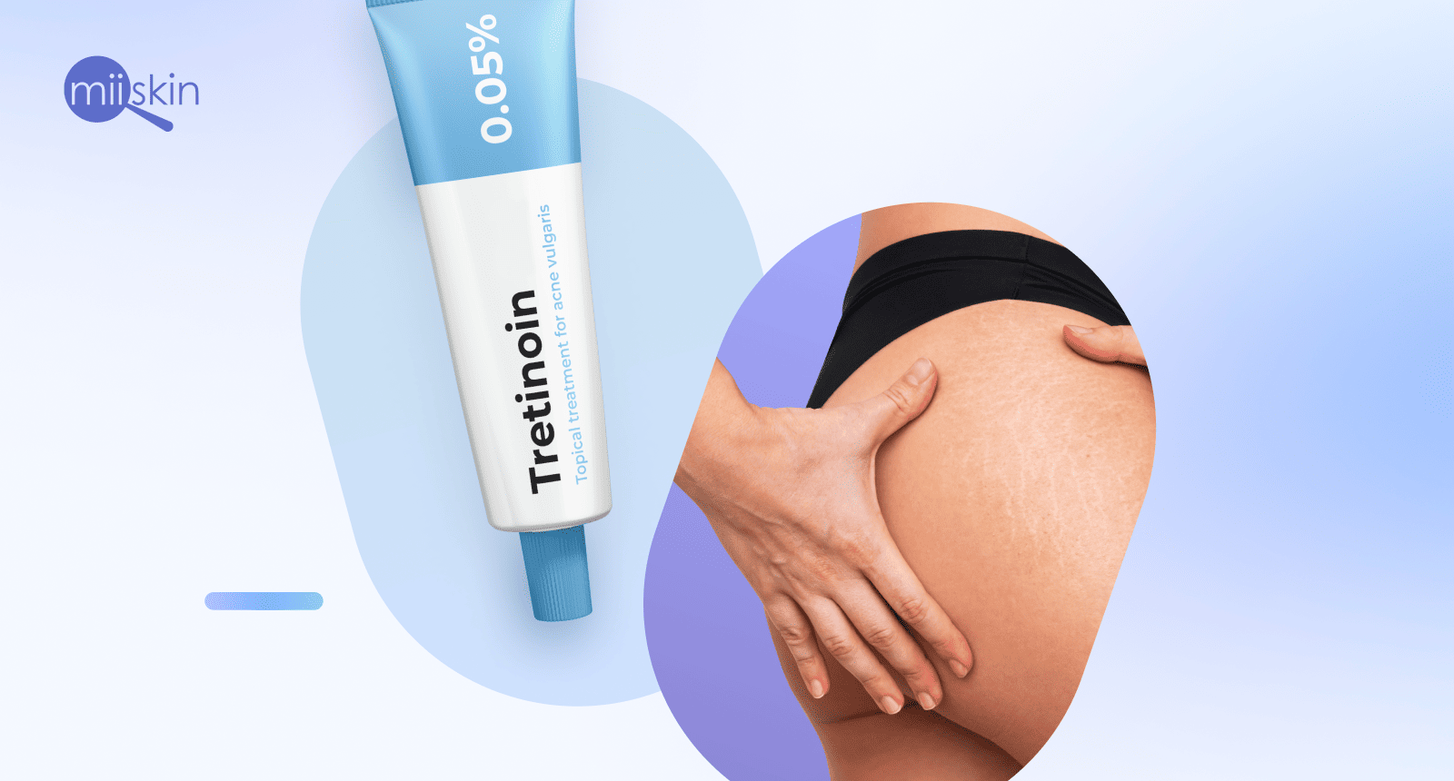 tretinoin for stretch marks