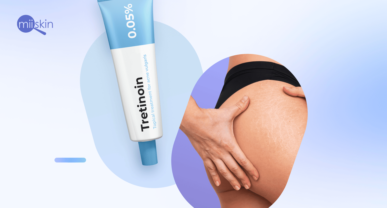 Does Tretinoin Work For Stretch Marks 