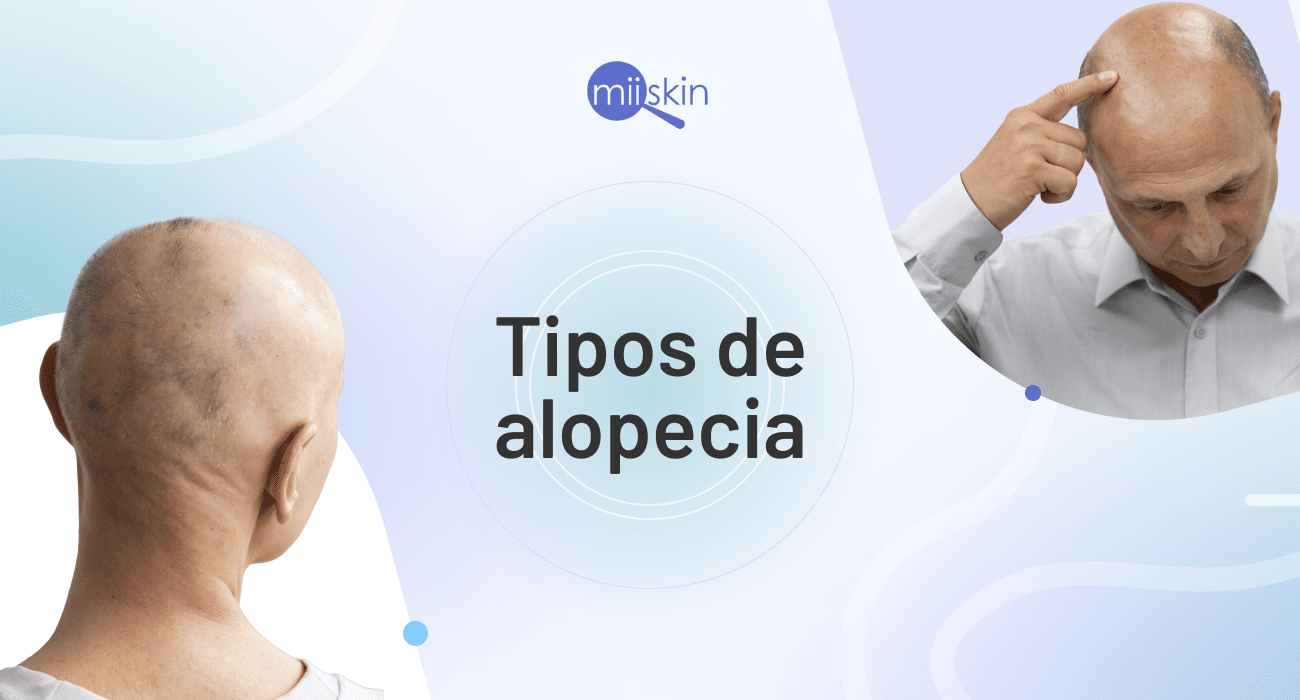 Clasificación de la alopecia