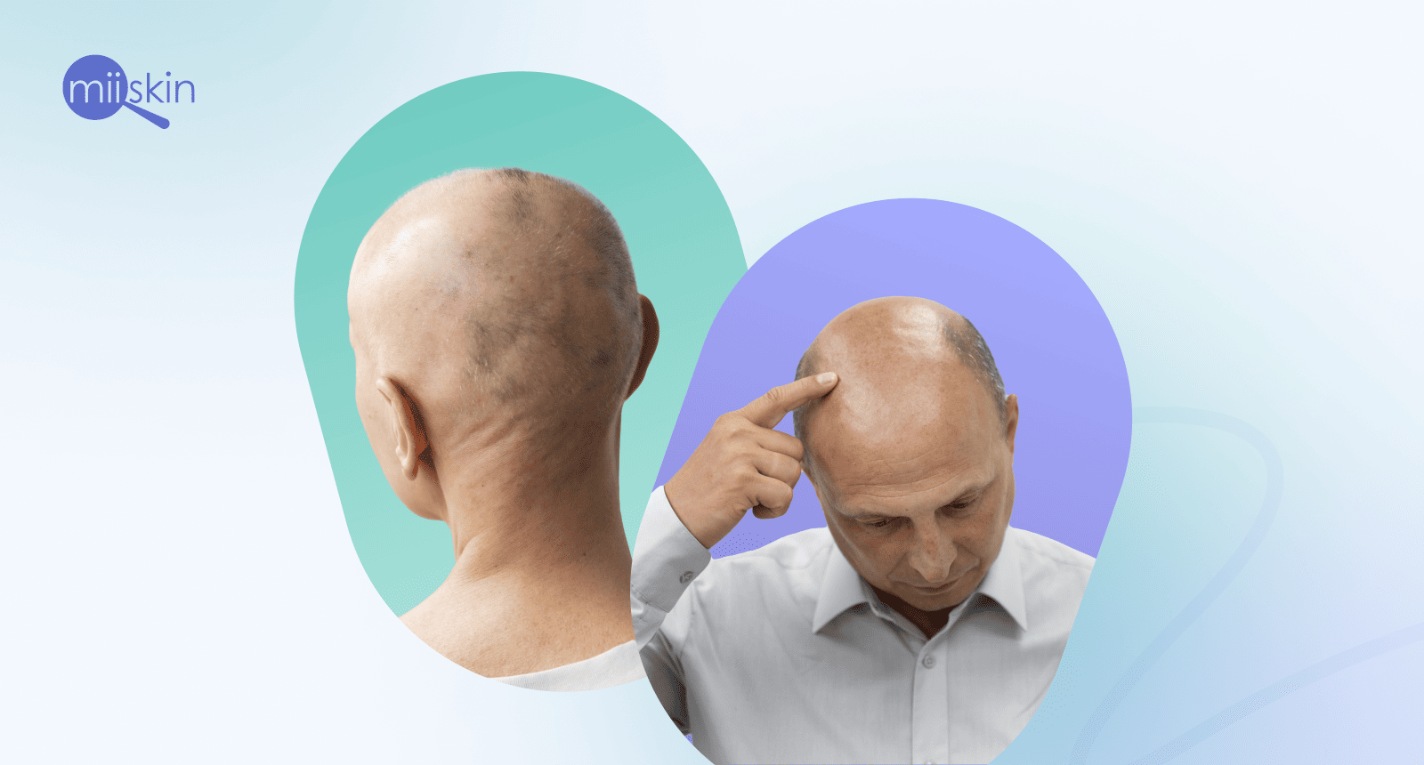 different types of alopecia