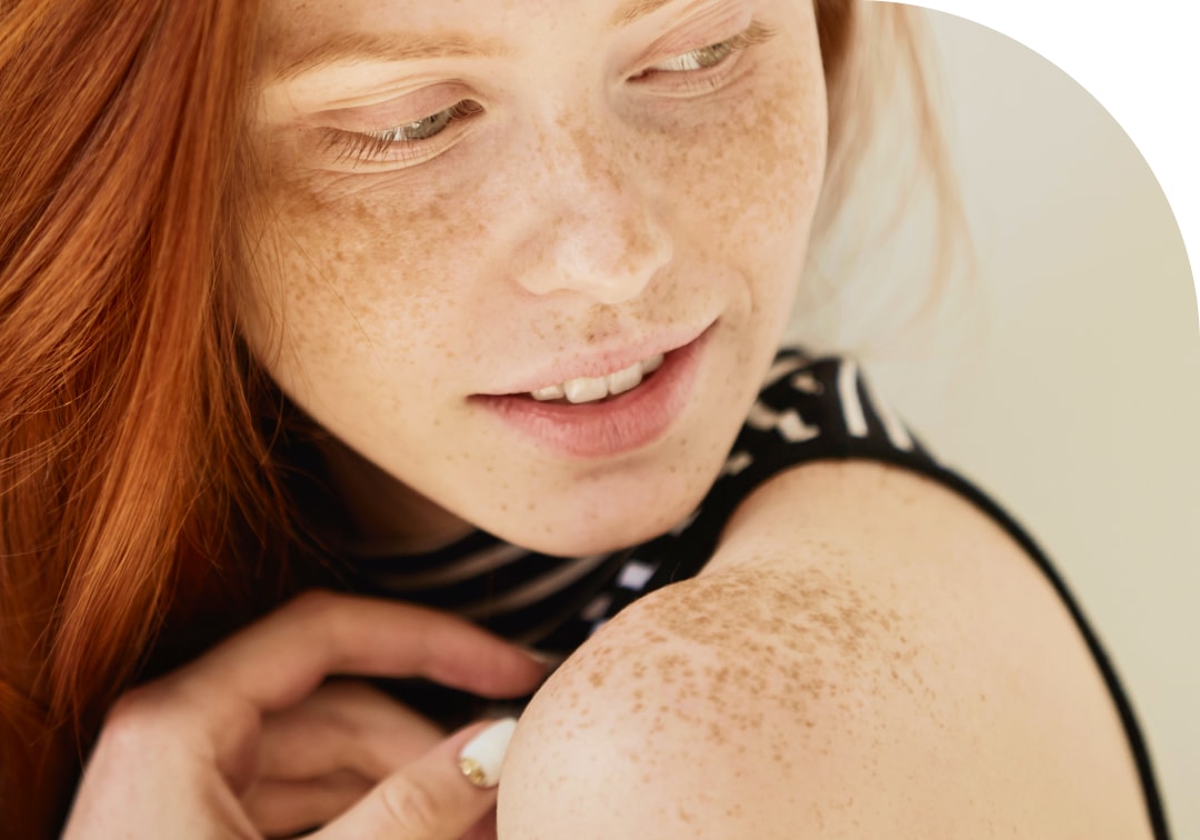 freckles skin