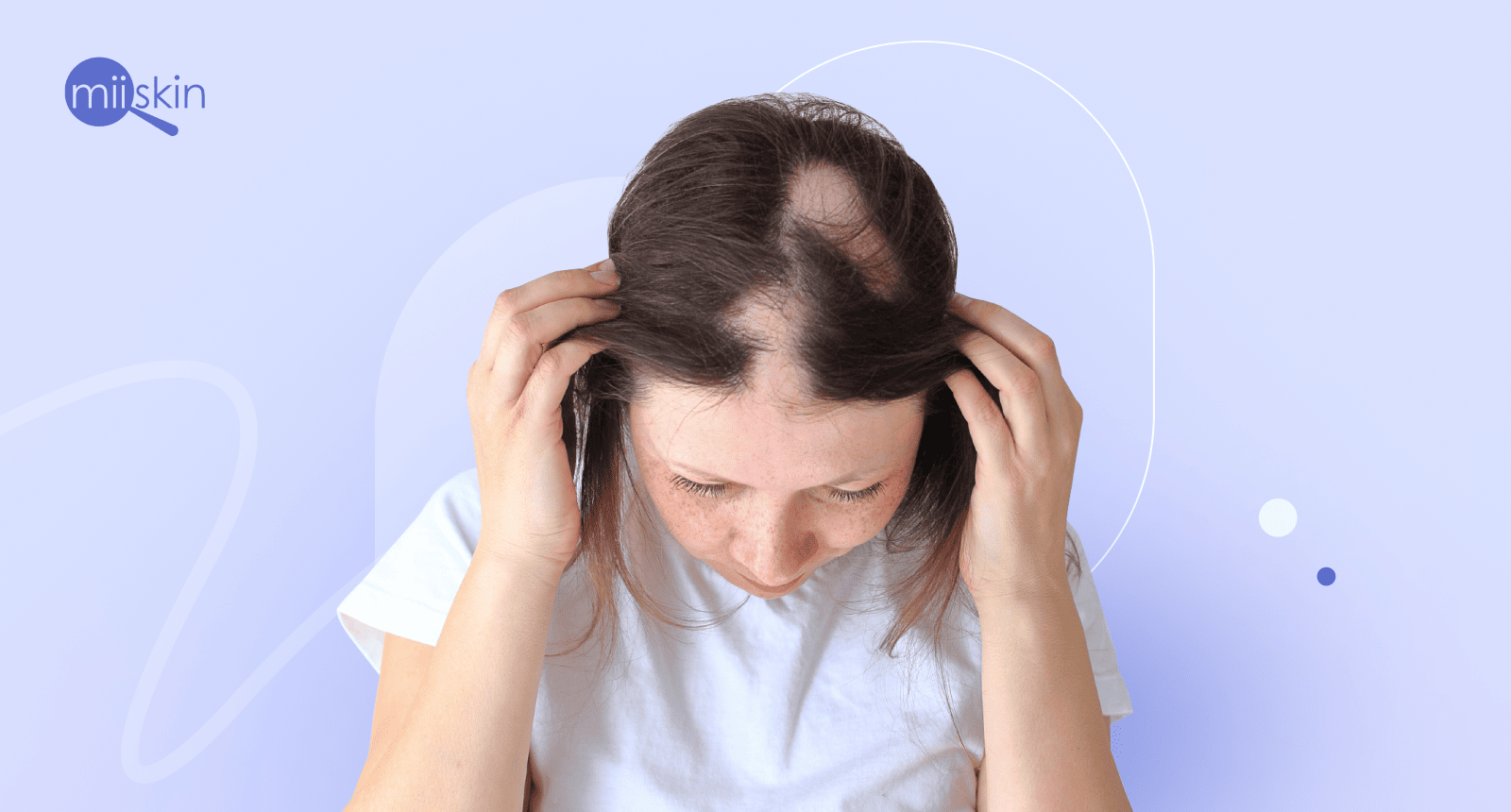 how to stop alopecia areata