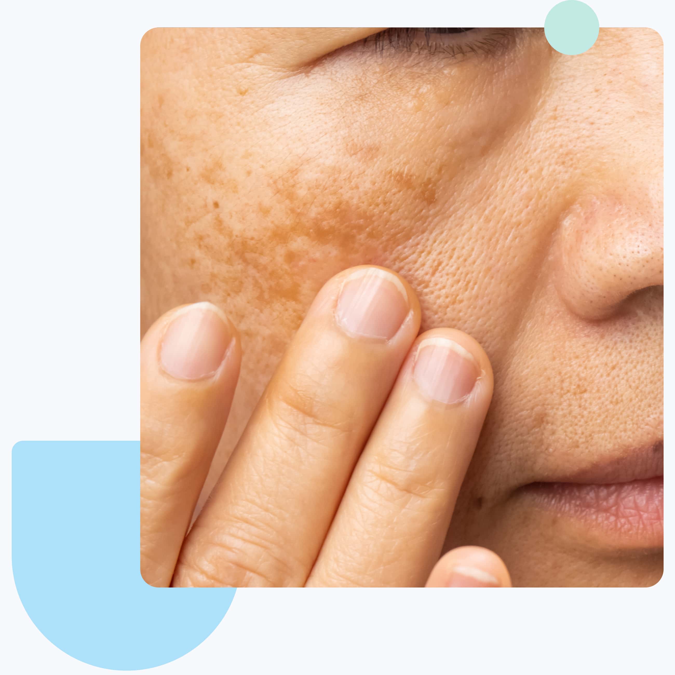 melasma management and therapy