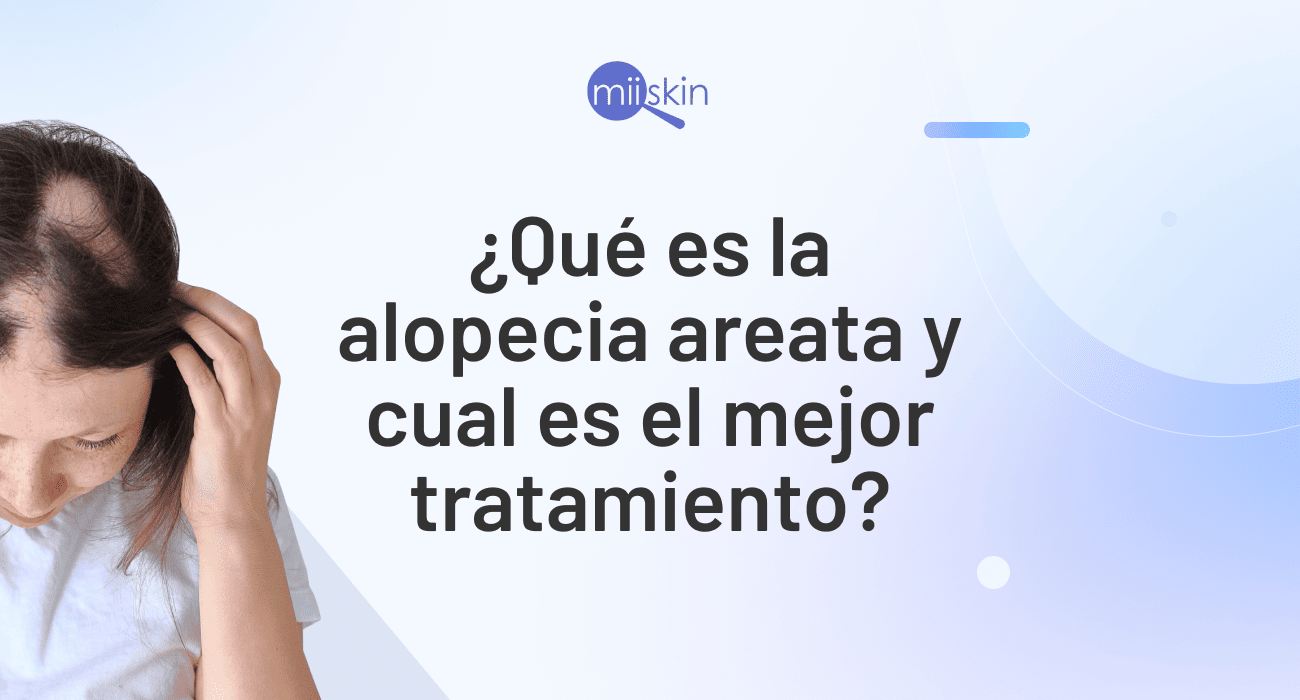 tratamiento alopecia areata