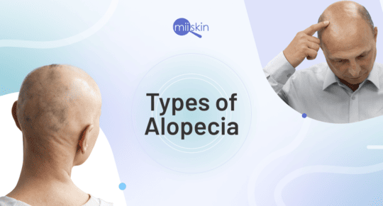 alopecia types