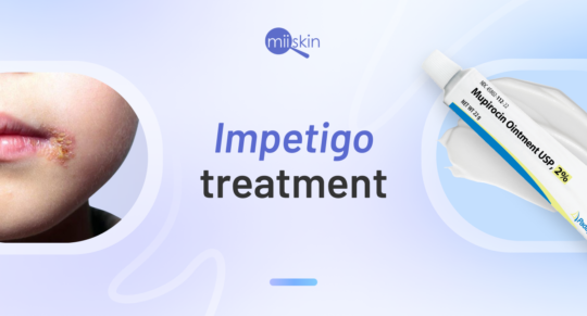 impetigo-prescription-treatment