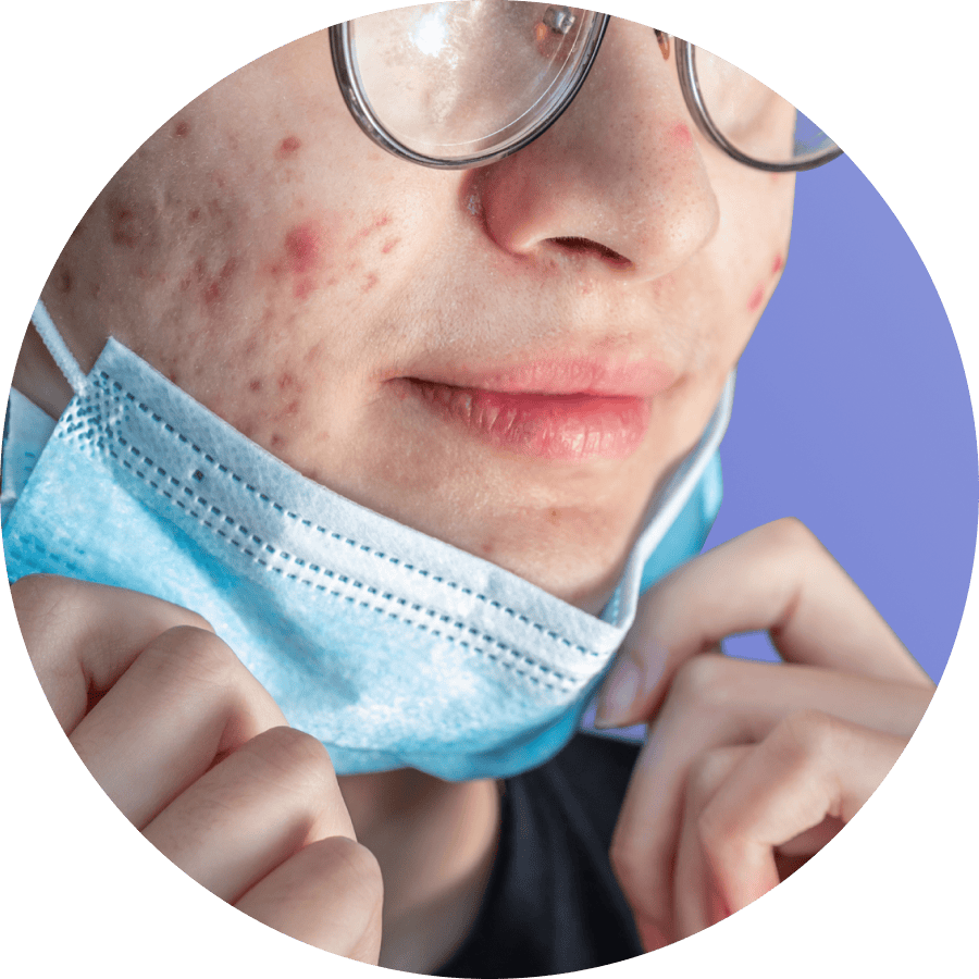 treatment for cystic acne
