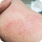 itchy rash