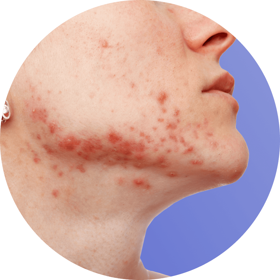 treatment for hormonal acne