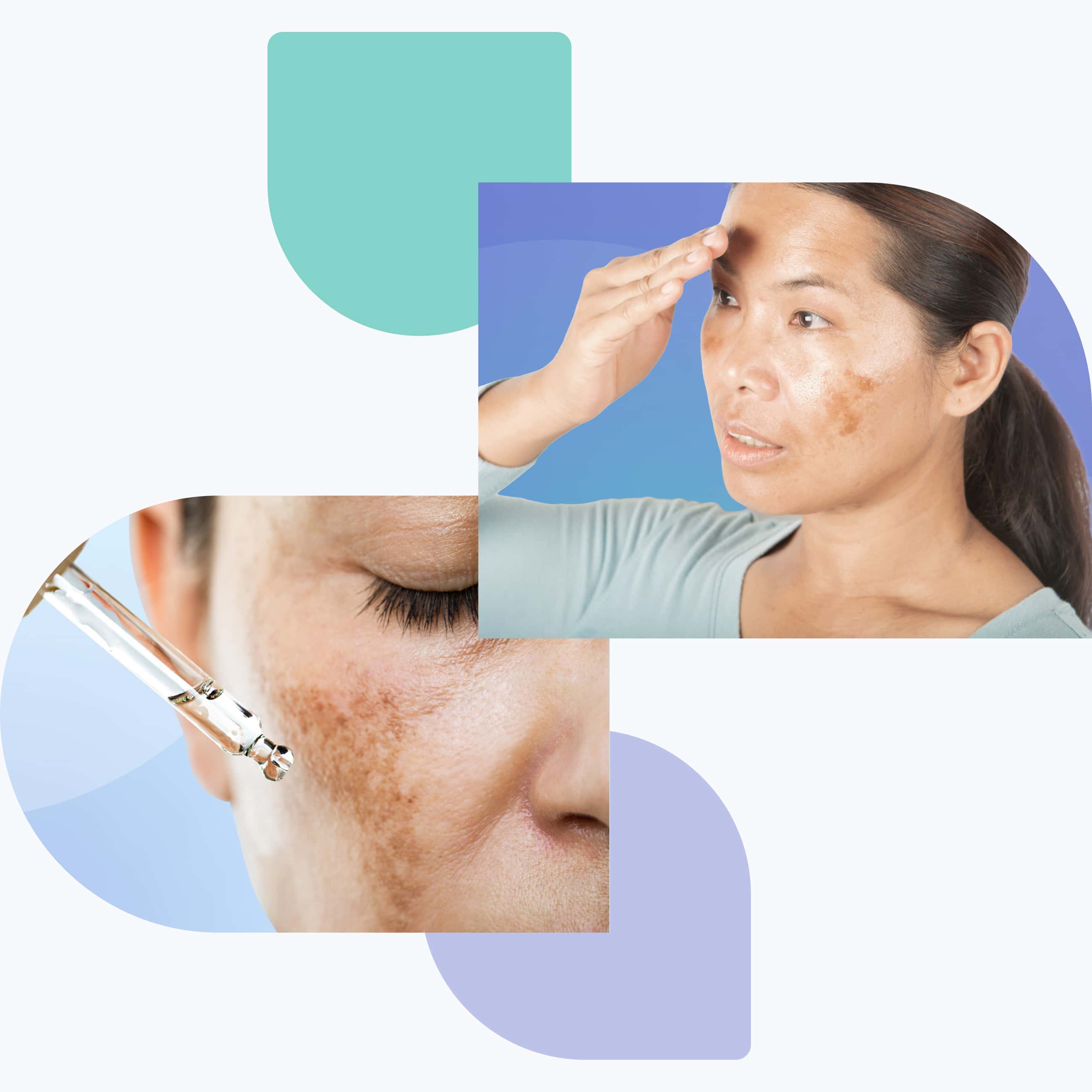 Tratamiento probado para el melasma