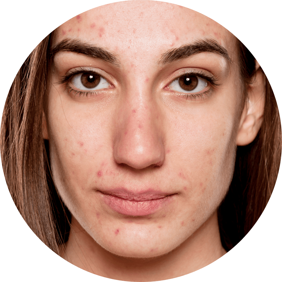 online treatment for mild acne