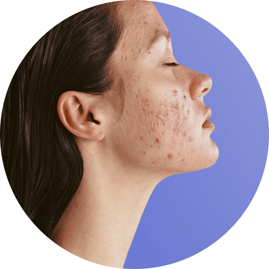 treatment for moderate acne