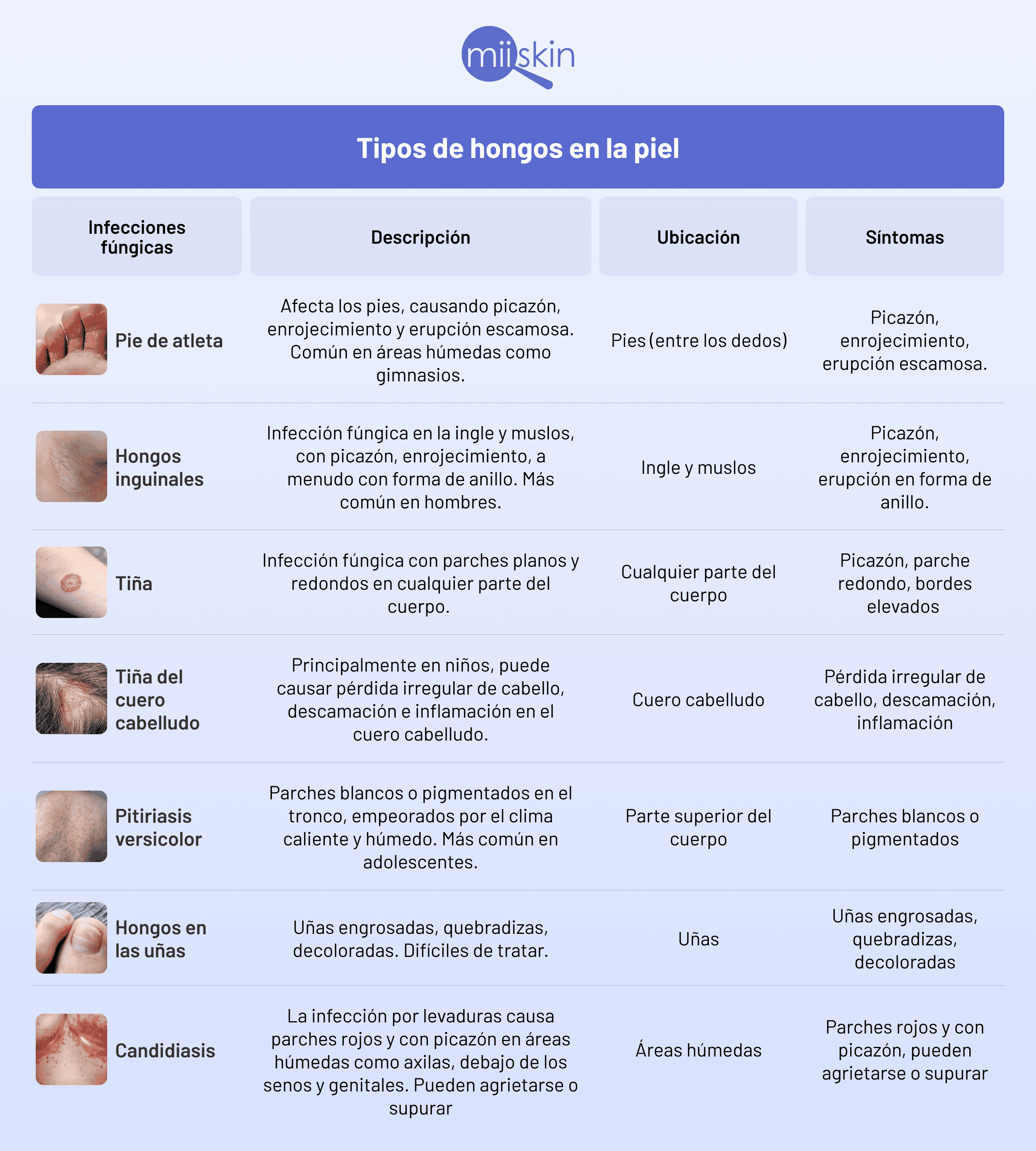 tipos de infecciones fungicas