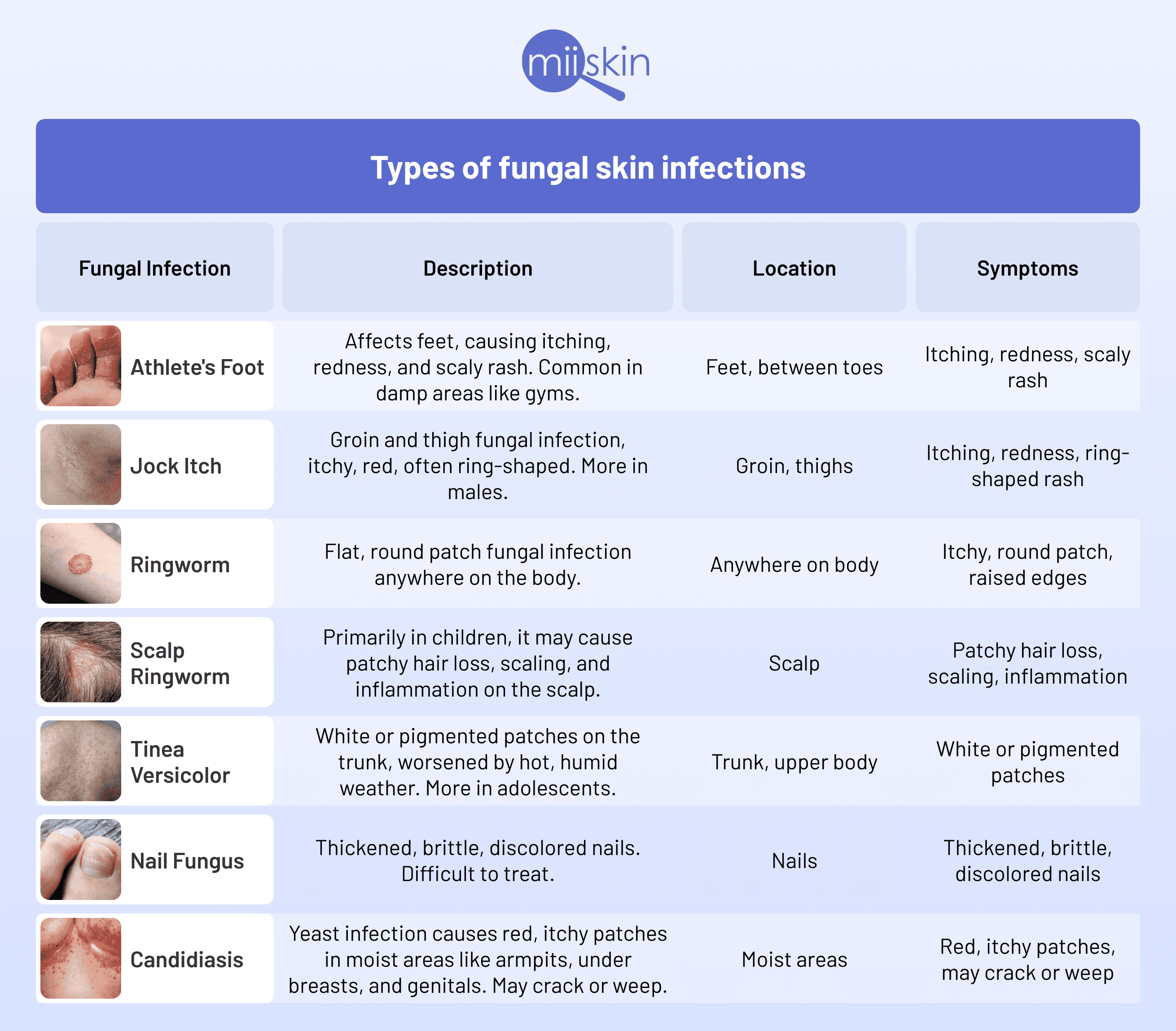 Can You Get An Antifungal Cream Over The Counter 