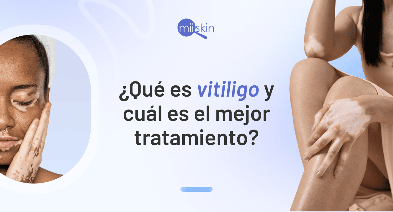 Guía dermatológica sobre vitiligo: Síntomas, causas y tratamiento