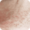 Dermatological rash