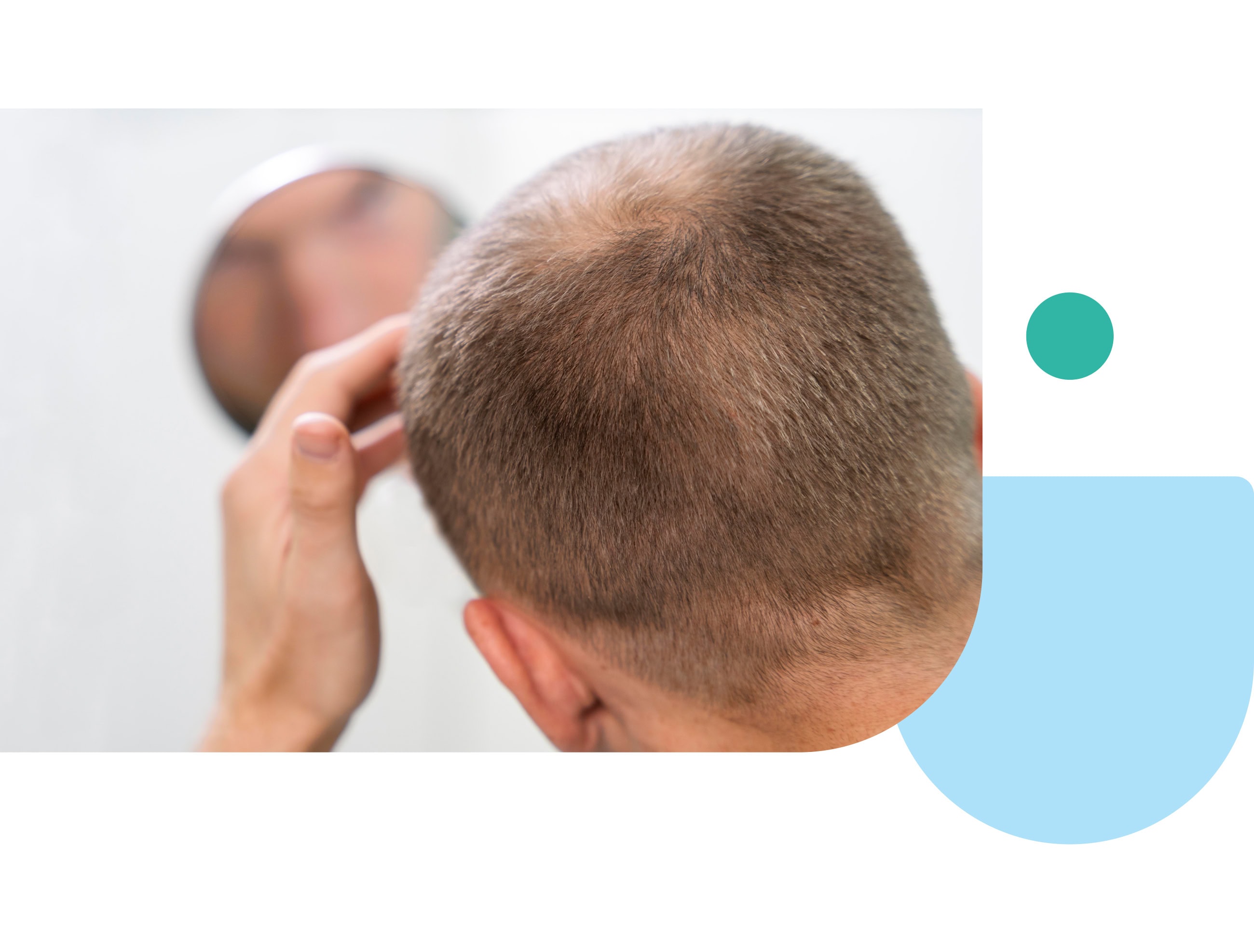 dutasteride prescription online for hair loss