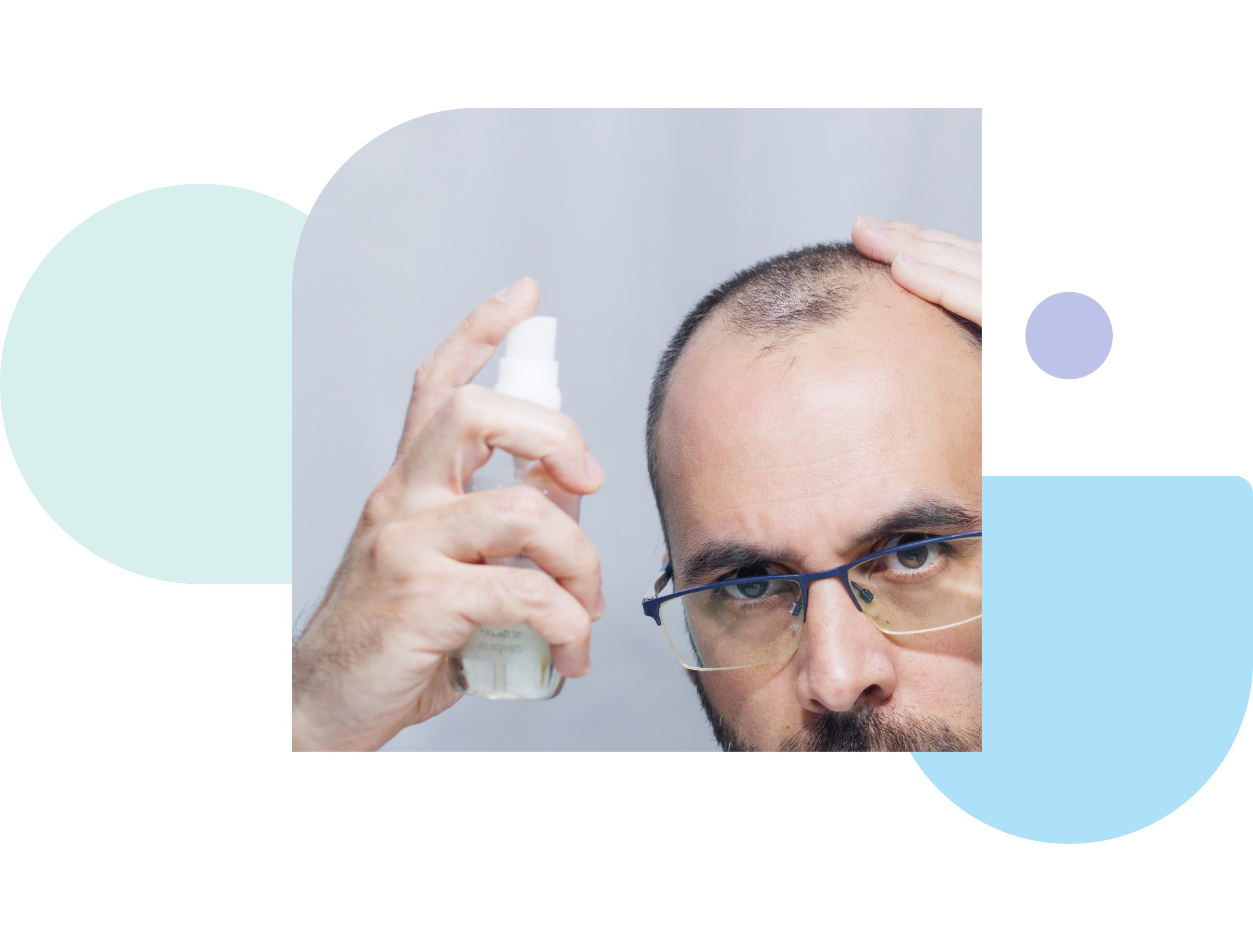 minoxidil and finasteride topical solutions for hair loss