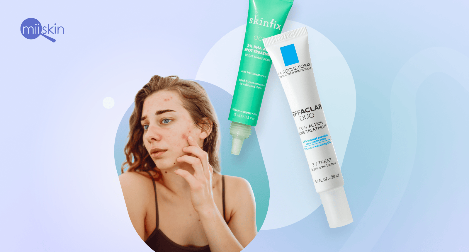 what are the most popular acne spot treatments